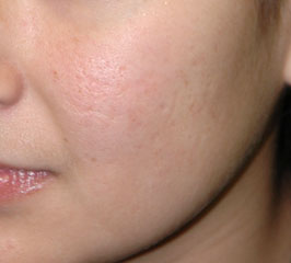 FRAXEL LASER RESURFACING - Patient 2 - Before